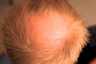 Photo of my bald spot