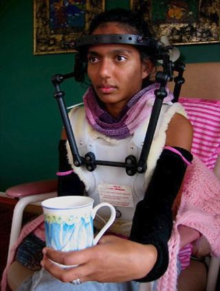 Photo of a woman in a medial device called a halo. She has a plastic cast on her chest and back with four arms attaching to a ring which in turn is drilled into her forehead.